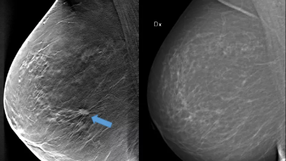 I bilden till vänster (en av ca 50 tunna bildskivor av bröstet) visas med hjälp av brösttomosyntes en ca 1 cm stor tumör som inte är säkert synlig på mammografibilden till höger, trots att bröstet inte innehåller särskilt mycket tät vävnad. Bildkälla: SUS