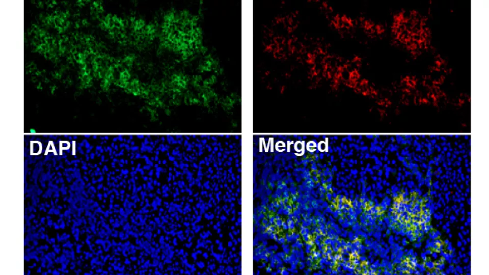 bild på Immunofluoroscence-analys av en melanomtumör som visar att B-celler i B-cellskluster uttrycker CXCR5, som är en markör för tertiära lymfoida strukturer.