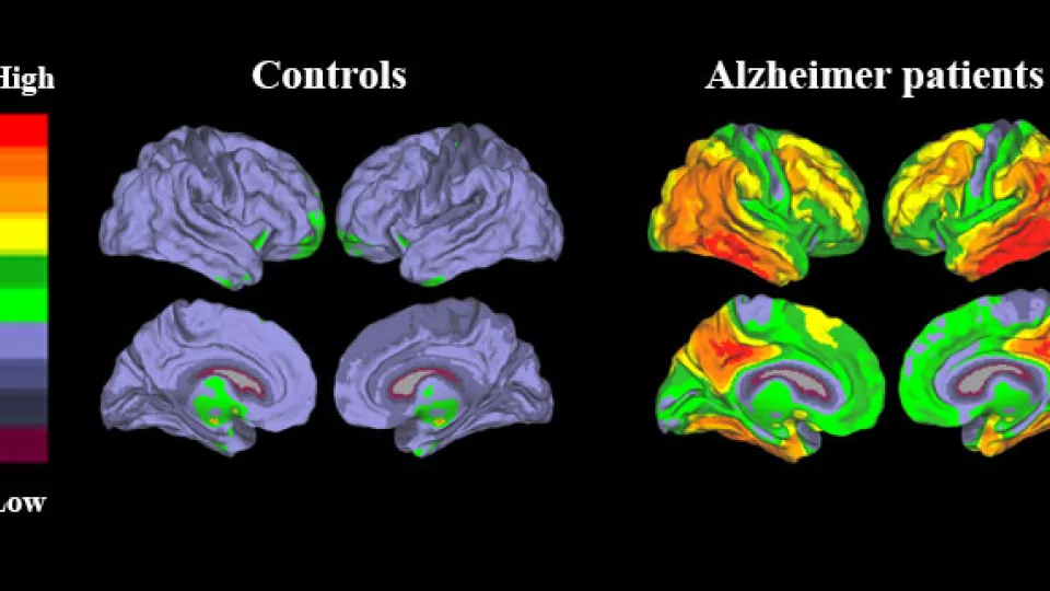 Tau PET visar på omfattande mängder av sjukligt tau protein i tinning- och hjäss-loberna hos patienter med Alzheimers sjukdom