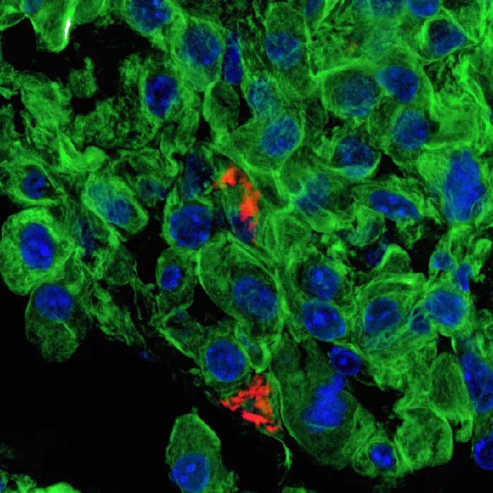 Confocal microscopy image showing nanoparticle uptake (red) in lung tumor cells (blue: nuclei, green: cytoskeleton)