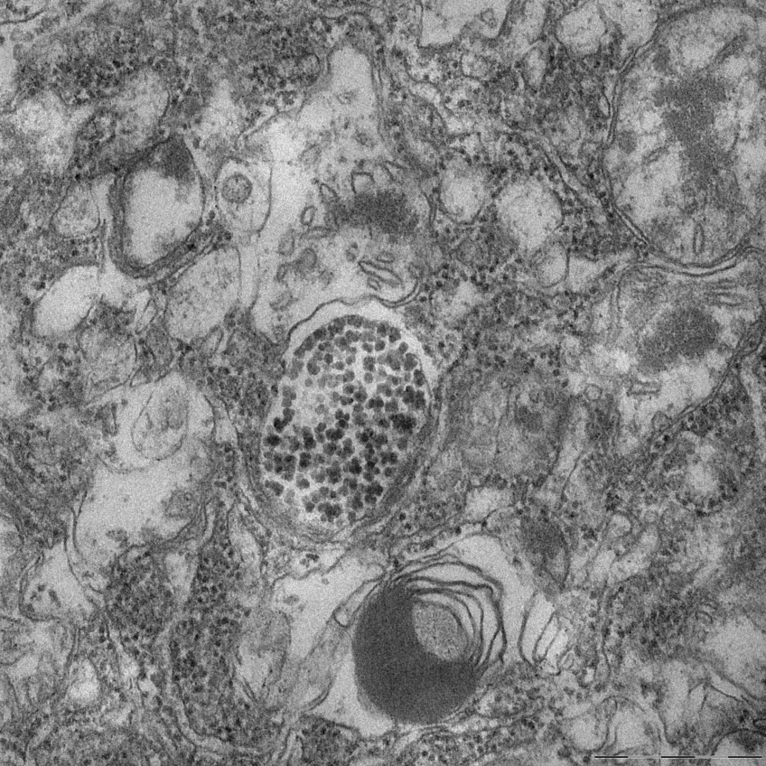Transmission electron microscopy image of nanoparticles inside lung tumor cells